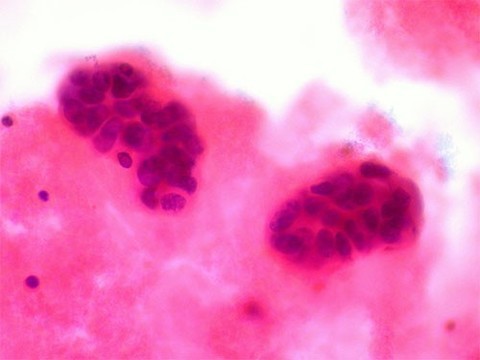 5 неочевидных признаков рака молочной железы — новости медицины